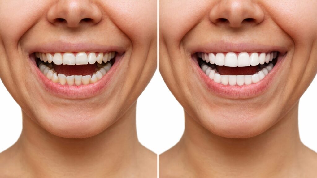 Teeth Whitening Before and After